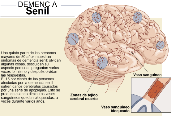 Demencia senil