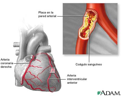 Corazón colesterol