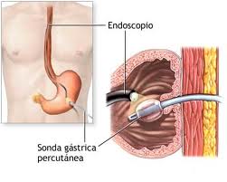 Nutrición enteral