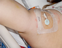 Nutrición parenteral